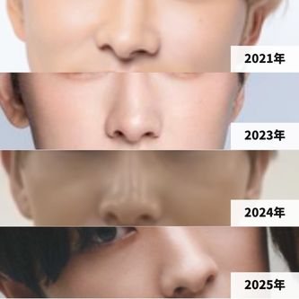 2021年、2023年~2025年までの、本多大夢の鼻の変化画像
