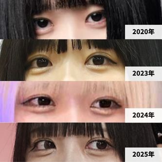 2020年、2023年～2025年までの、あのちゃんの涙袋の変化画像