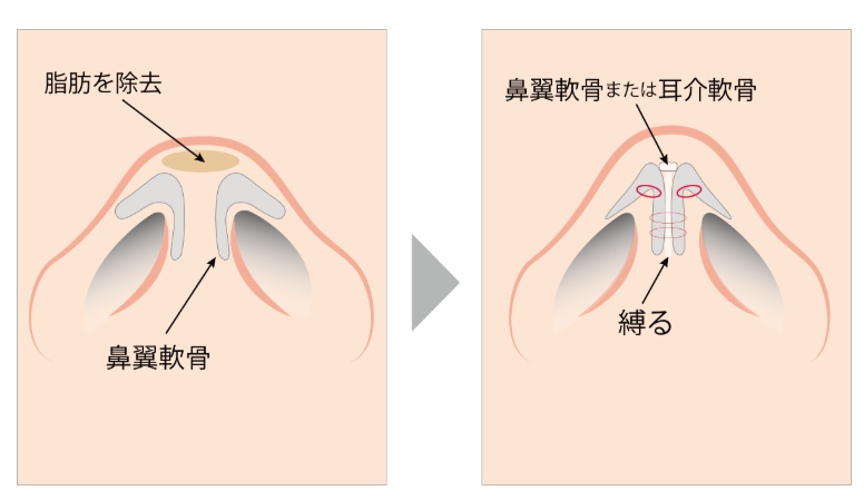 ベル美容外科クリニックによる鼻尖形成の説明画像
