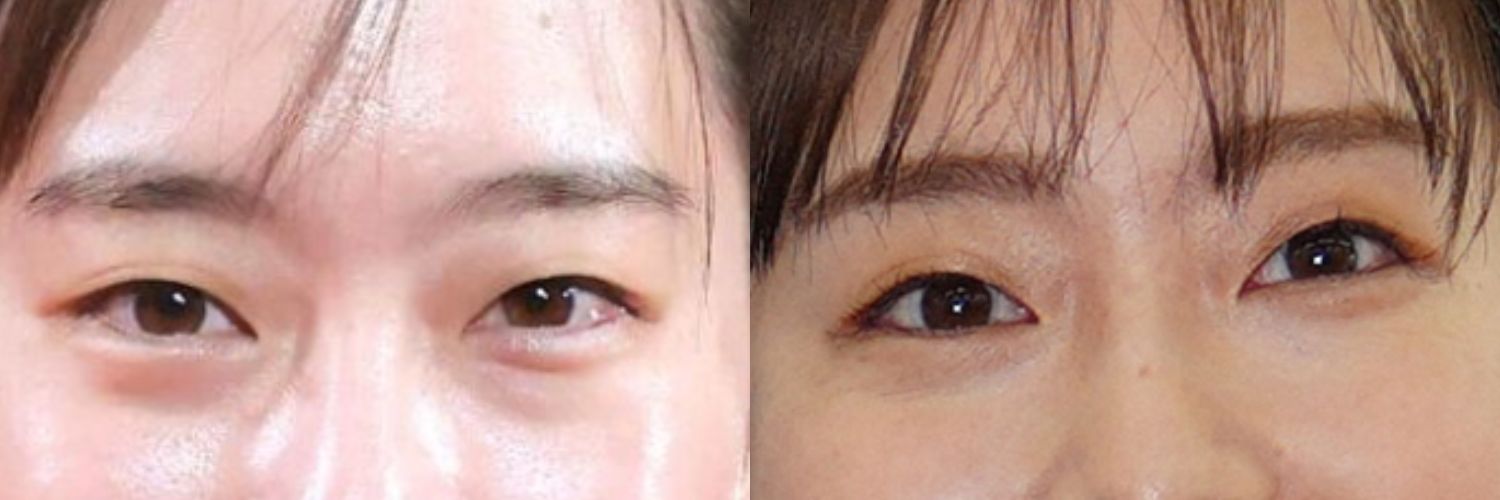 石川佳純の現役時代と現在の目元の比較画像