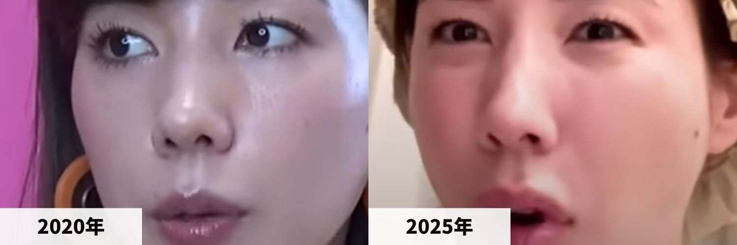2020年と2025年の仲里依紗さんの鼻の比較画像