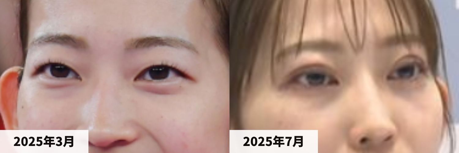 2025年3月と2025年7月の松山奈未選手の目元の比較画像