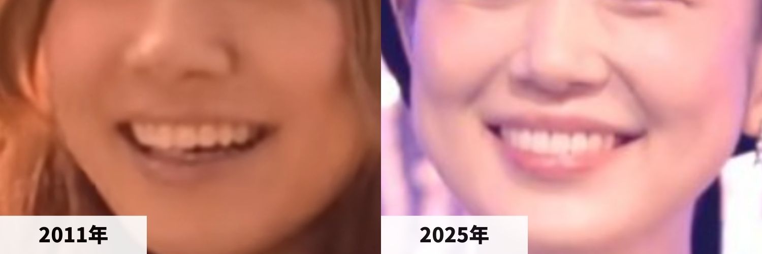 2011年と2025年の西野カナさんの口元の比較画像