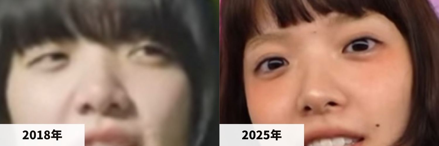 2018年と2025年のあいみょんさんの鼻の比較画像