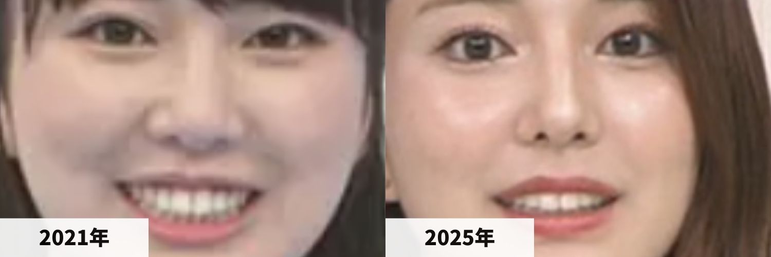 2021年と2025年の黒田みゆアナの鼻の比較画像