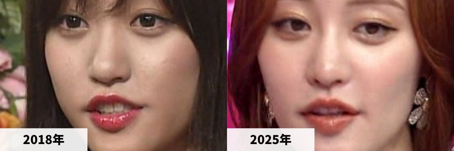 2018年と2025年の王林さんの鼻の比較画像