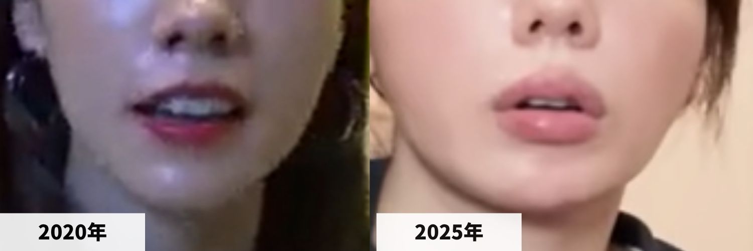 2020年と2025年の仲里依紗さんの唇の比較画像