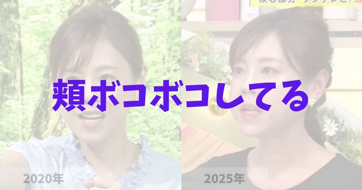 高橋真麻の頬（ほっぺた）がボコボコしてるけど整形失敗？の記事