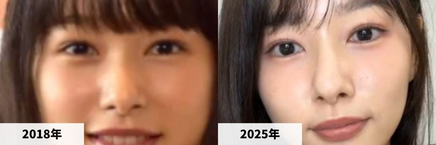 2018年と2025年の桜井日奈子さんの鼻の比較画像