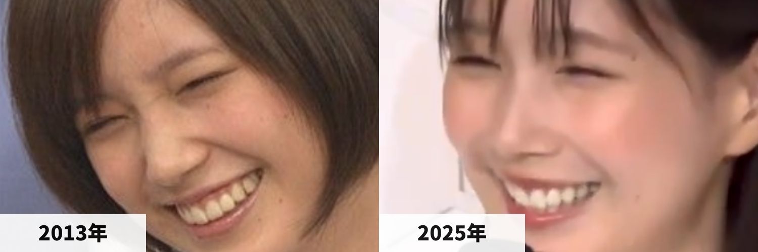 2013年と2025年の本田翼の鼻筋の比較画像