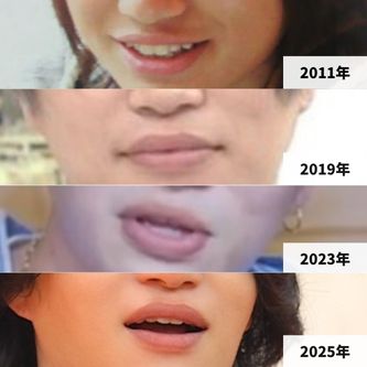2011年・2019年・2023年・2025年の菊池風磨さんの唇の比較画像