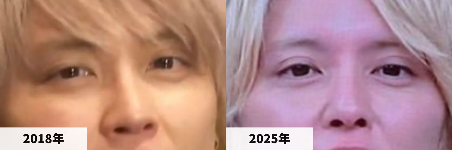 2018年と2025年の手越祐也さんの目元の比較画像