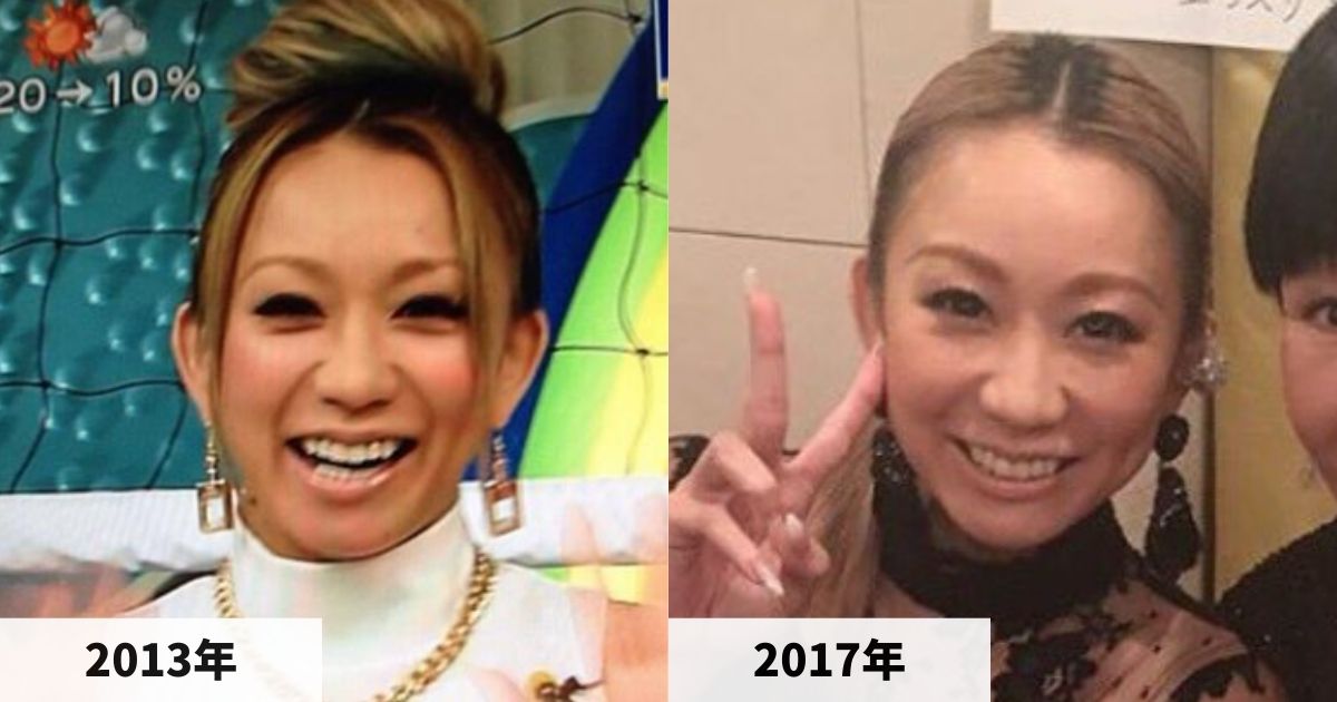 2013年と2017年の倖田來未さんの顔の比較画像