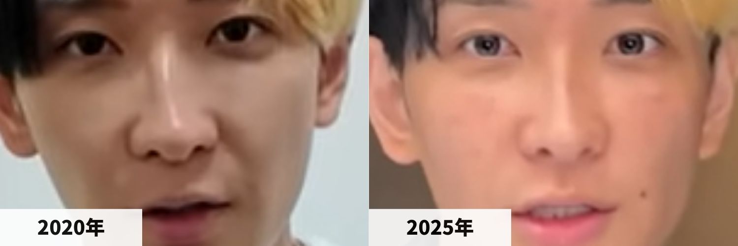 2020年と2025年のヒカルさんの鼻の比較画像