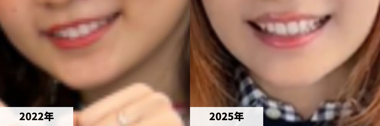 2022年と2025年の幾田りらさんのアゴの比較画像