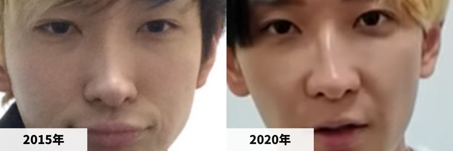 2015年と2020年のヒカルさんの鼻の比較画像
