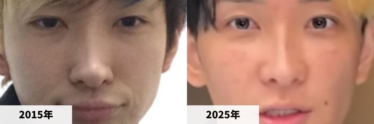 2015年と2025年のヒカルさんの鼻の比較画像