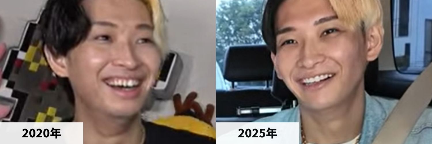 2020年と2025年のヒカルさんの口元の比較画像