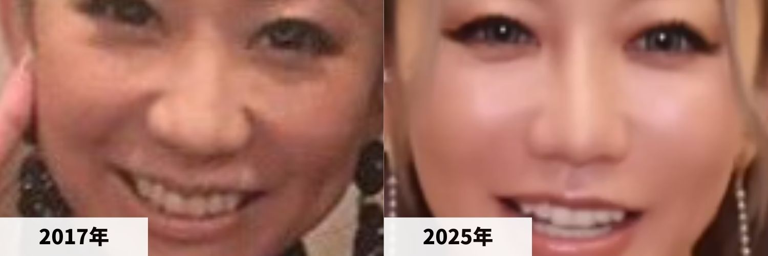 2017年と2025年の倖田來未さんの鼻の比較画像
