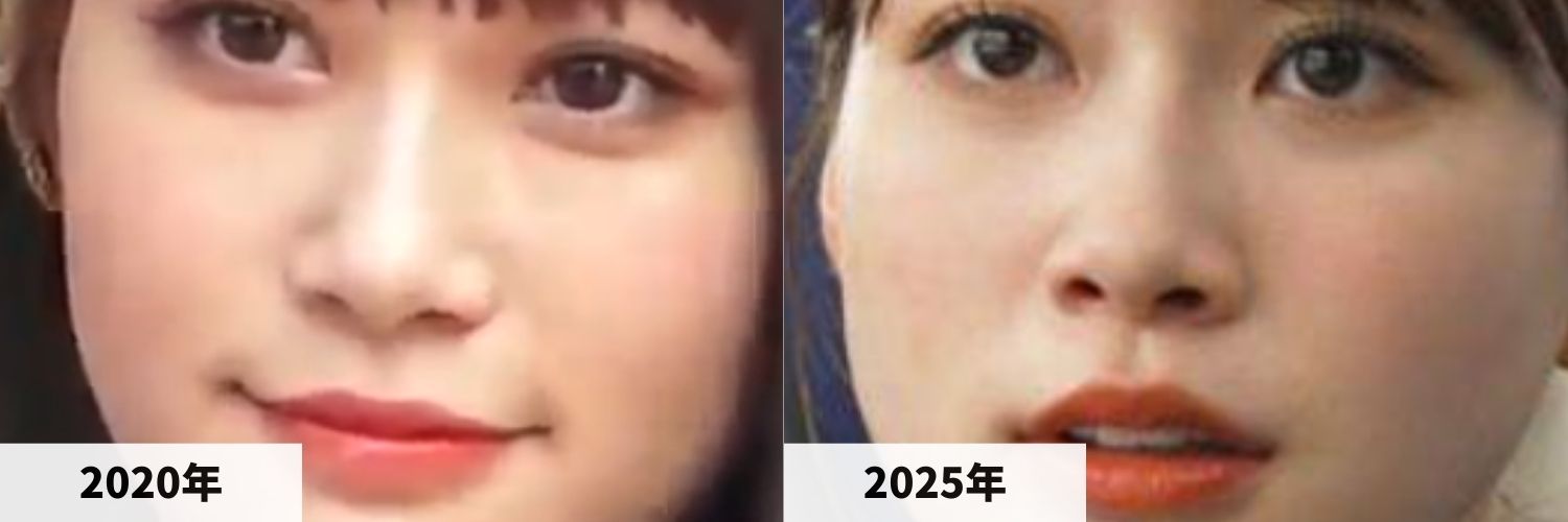2020年と2025年のめるるさんの鼻の比較画像
