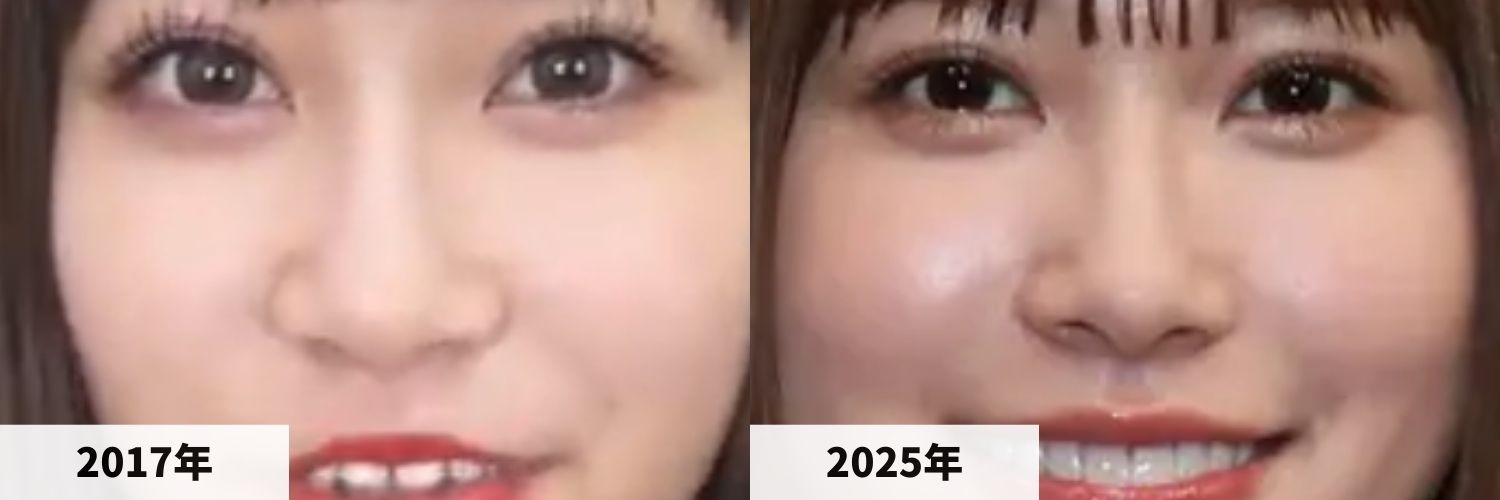 2017年と2025年のめるるさんの鼻の比較画像