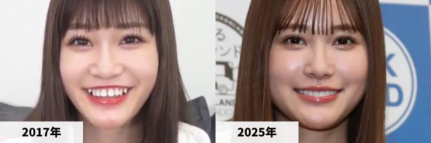 2017年と2025年のめるるさんの口元の比較画像