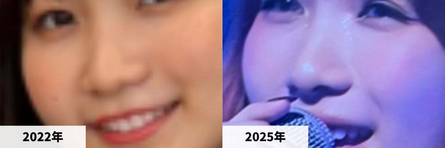 2022年と2025年の幾田りらさんの鼻の比較画像
