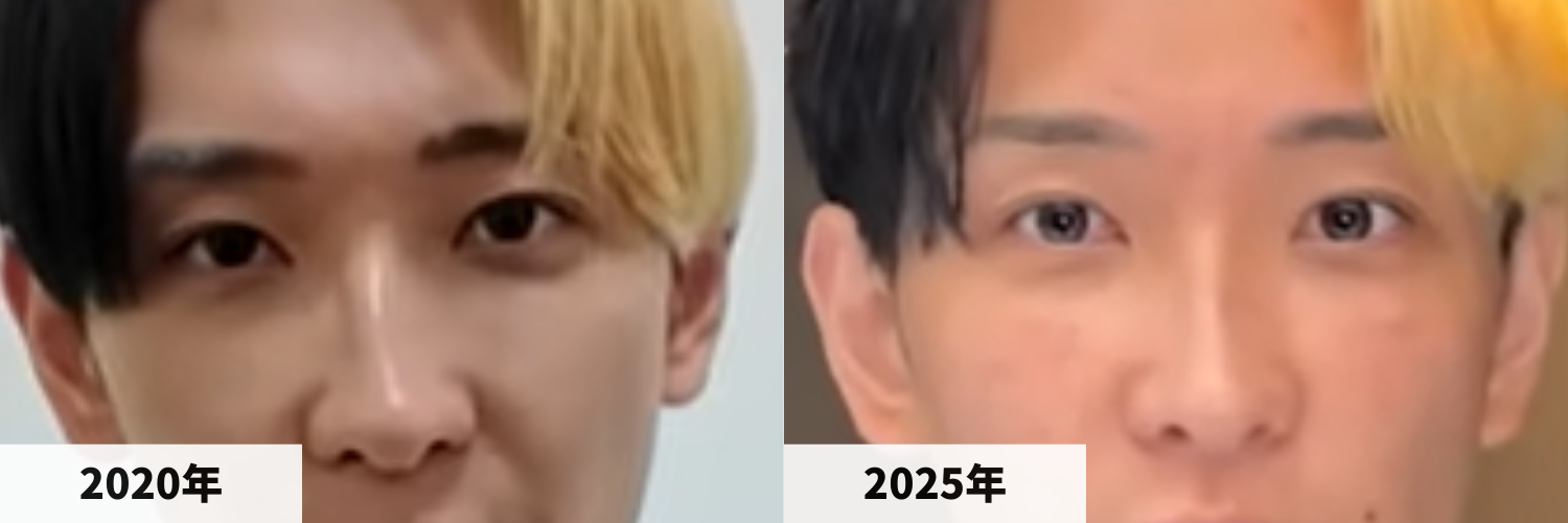 2020年と2025年のヒカルさんの目元の比較画像